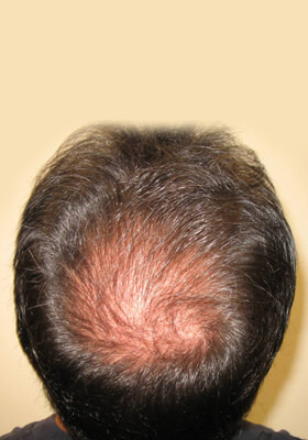 hair transplant before after Photos