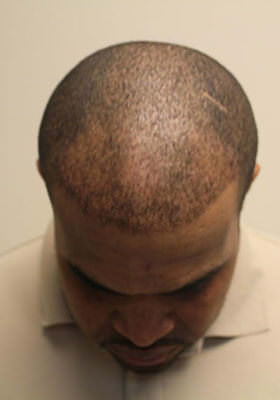 hair transplant before after Photos