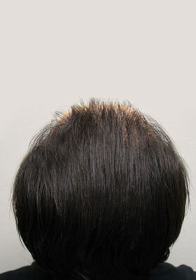 hair transplant photos