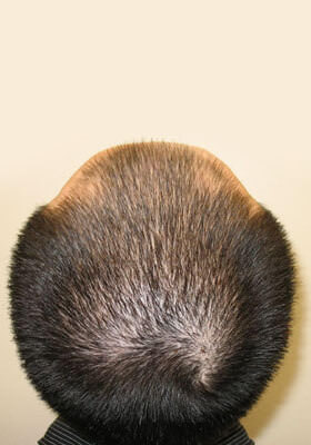 hair transplant photos