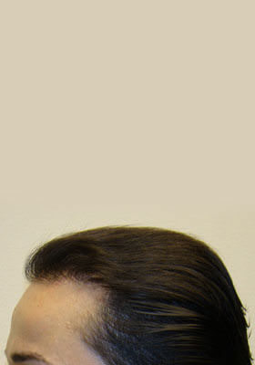 hair transplant photos