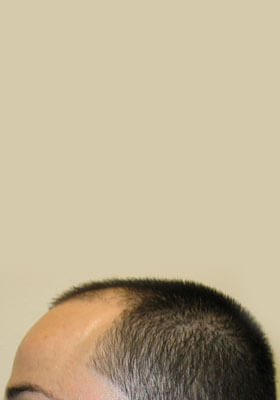 hair transplant photos