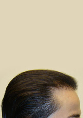 hair transplant photos