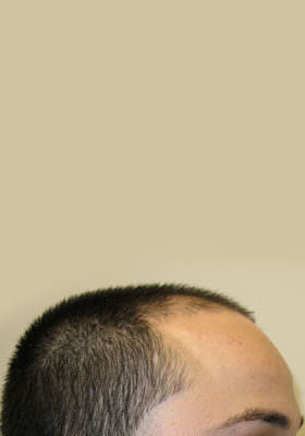 hair transplant photos