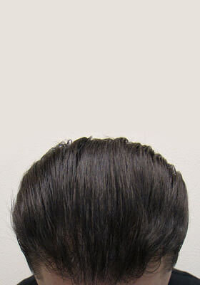 hair transplant photos