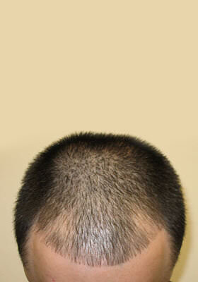 hair transplant photos