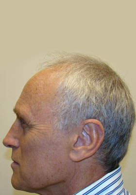 hair transplant photos