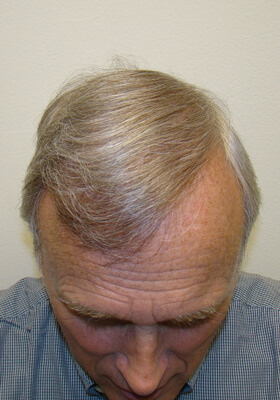 hair transplant before after Photos