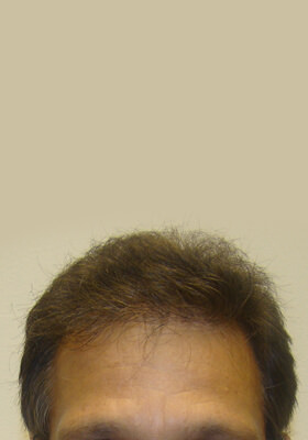 hair transplant photos