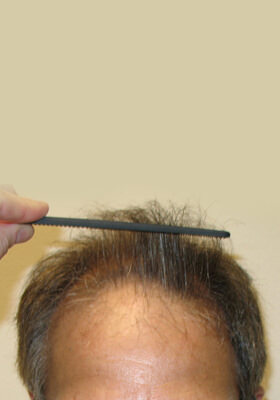 hair transplant photos