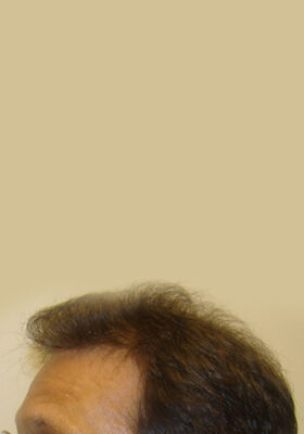 hair transplant photos