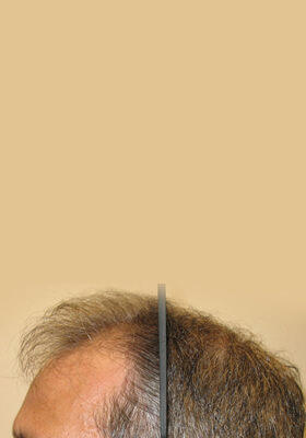 hair transplant photos