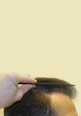 hair transplant photos