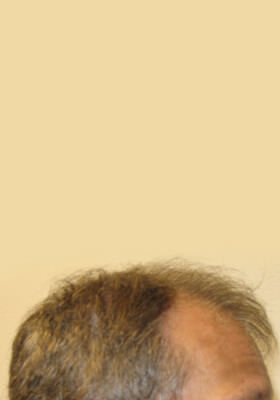 hair transplant photos