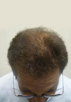 hair transplant photos