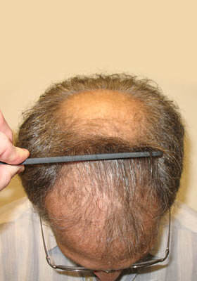 hair transplant photos