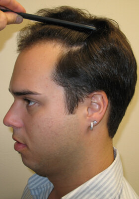 hair transplant photos