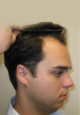 hair transplant photos