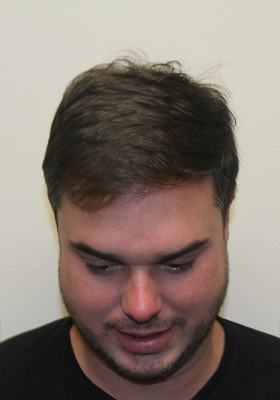 hair transplant photos