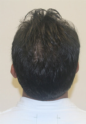 hair transplant before after Photos