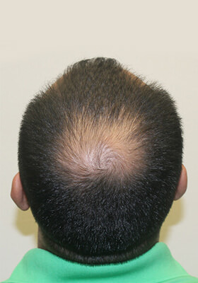 hair transplant before after Photos