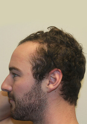 hair transplant photos