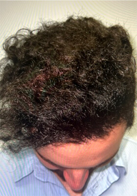 hair transplant photos