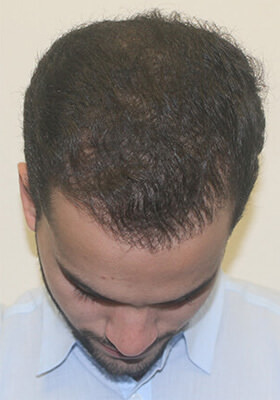 hair transplant before after Photos