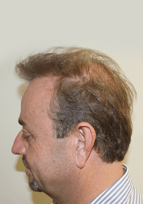 hair transplant photos