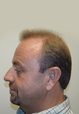 hair transplant photos