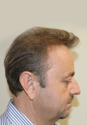 hair transplant photos