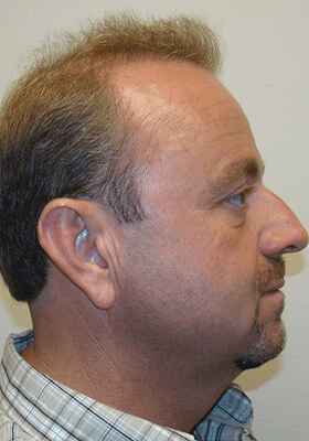 hair transplant photos