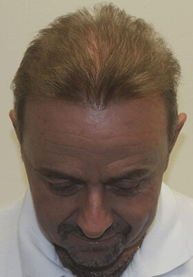 hair transplant photos