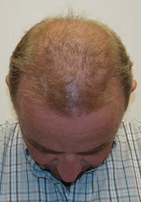 hair transplant photos