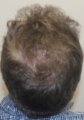 hair transplant photos