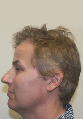 hair transplant photos