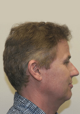 hair transplant photos