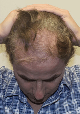 hair transplant photos