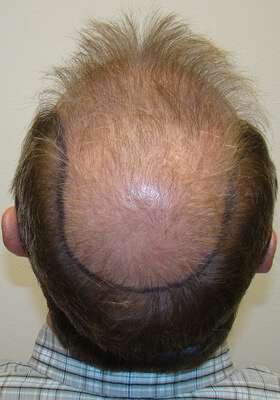 hair transplant before after Photos