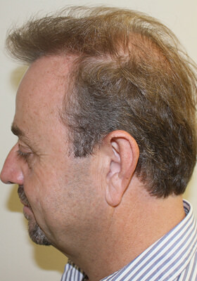 hair transplant photos