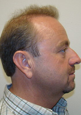 hair transplant photos