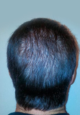 hair transplant photos