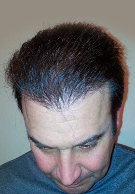 hair transplant photos