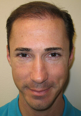 hair transplant photos