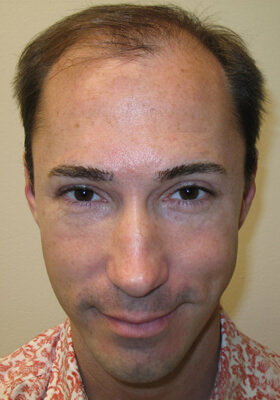 hair transplant photos