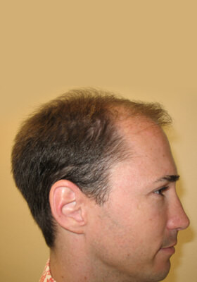 hair transplant photos