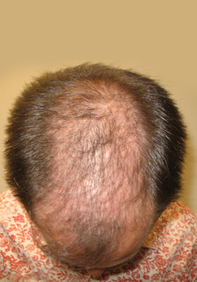 hair transplant photos