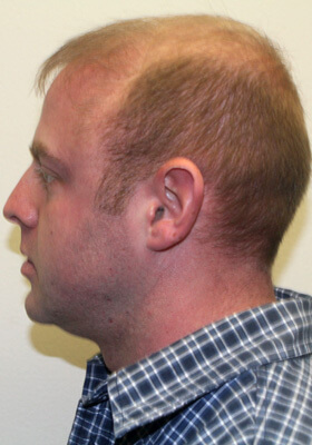 hair transplant photos