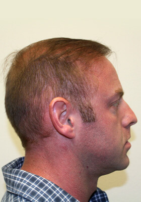 hair transplant photos