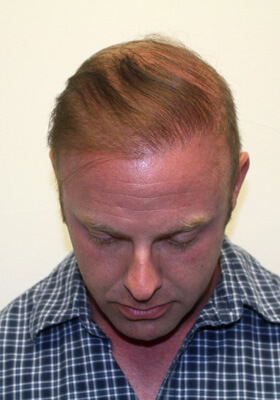 hair transplant photos